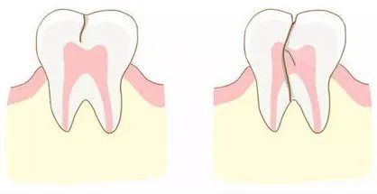 牙隱裂科普 | 有些牙表面看起來好好的，其實已成“隱形脆皮”！
