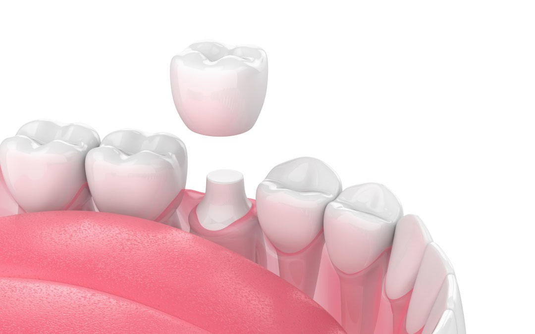 假白厚重上鏡丑？幾百塊的烤瓷牙被狂罵，真有這么差?