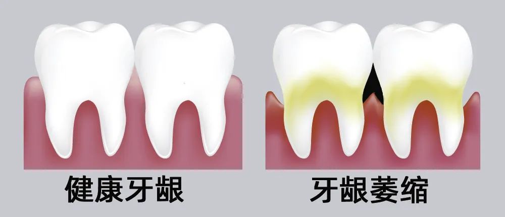 牙縫大露出“黑三角”，既塞牙又難看！還能恢復(fù)嗎？